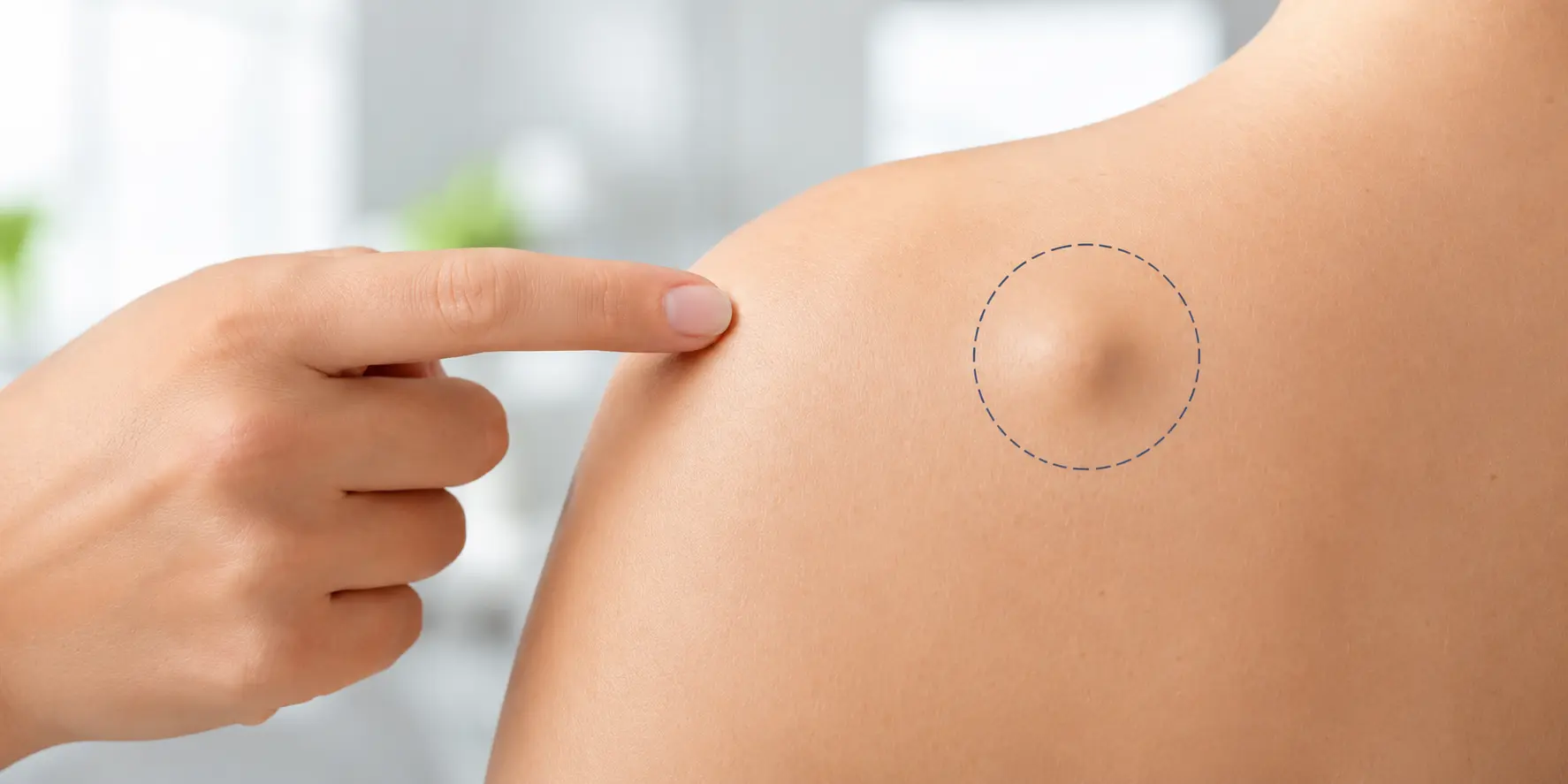 Retiro de lipoma en Mérida con el Dr. Francisco Góngora